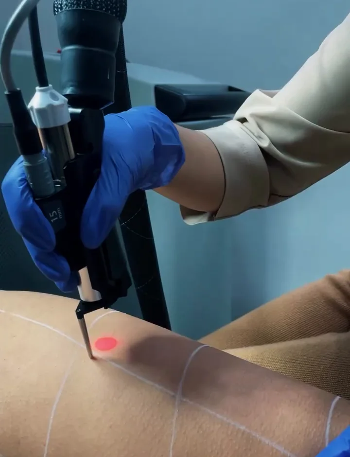 Séance d'épilation laser sur la jambe au cabinet de Dr Yousra El Khadri à Casablanca